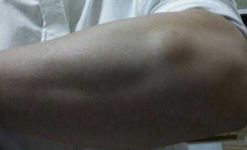 小方子|治“脂肪瘤”的小方子来了！偷学来的险招，治疙瘩不痛、不痒