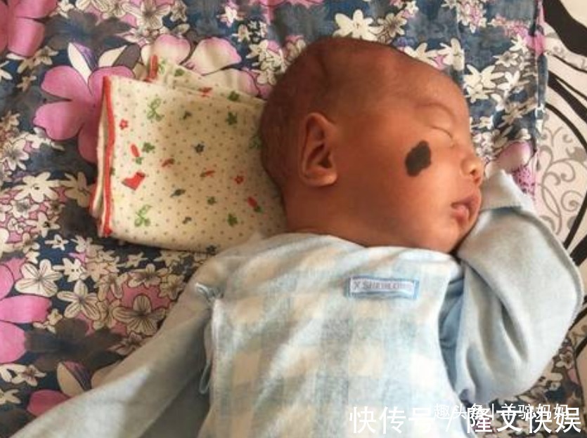 血管瘤|越来越多胎儿被“胎记”缠身,若不想孩子自卑,孕妈要管住自己