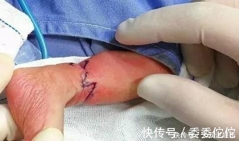 农药残留|胎儿在妈妈肚中被绑腿，出生后被告知要截肢，宝妈瘫地痛哭