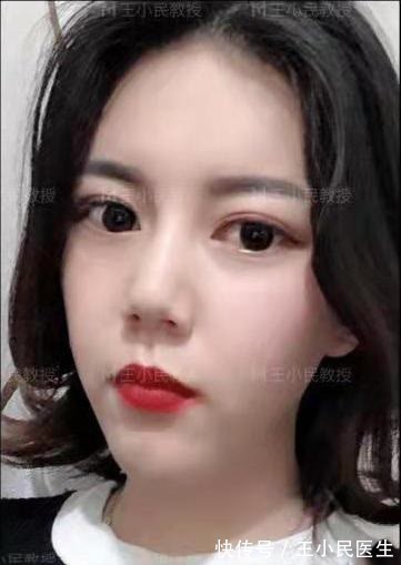 王小民 面部提升王小民教授:小拉皮定格青春,30岁仍然如花似玉!