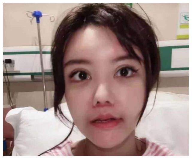 疤痕|韩安冉急于展示整容效果，蓬头垢面疤痕明显，为博关注下了手术就拍视频