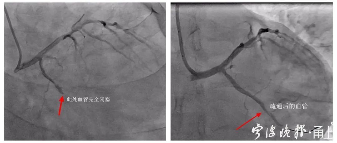急诊|游戏玩到凌晨3点,27岁男子突然胸痛!医院一周连收4例都是年轻人