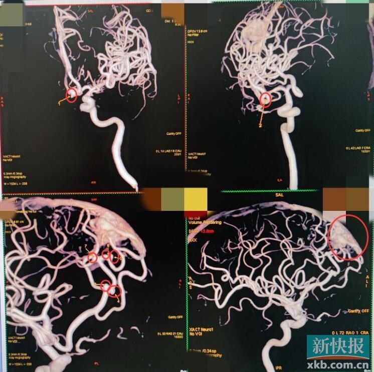 对症治疗|女子颅内长7个动脉瘤 医生：相当于7个“不定时炸弹”
