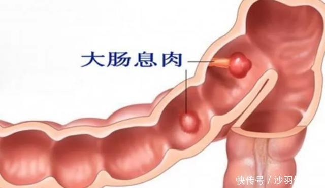 体检查出结节、息肉、增生、囊肿，哪个是癌症