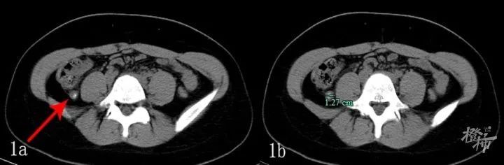 医生|24岁姑娘要割阑尾,医生用一根“管子”救了她
