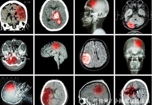 脑梗为何逐年增多?医生:别总冤枉肥肉,3种调料要少吃,莫忽视