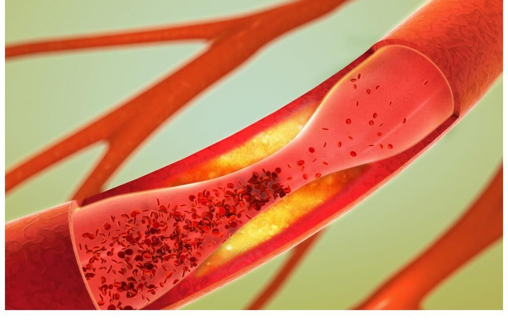 甘油三酯|血管的“清洁工”被发现，不是木耳，每天坚持吃，血管越来越干净