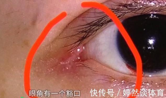 开眼角 姑娘做“开眼角”，术后却感觉眼睛不对劲？医生：确实少缝了一针