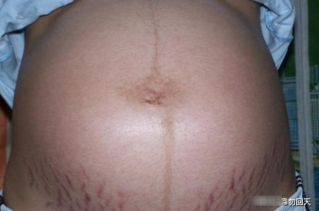 纹路|有些孕妈为何会出现“妊娠纹”，但有些孕妈却没长？大夫讲了内情