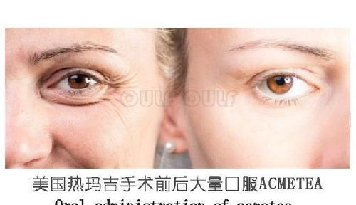 什么是热玛吉你真想不到、【热玛三太】吃多久提升效果？