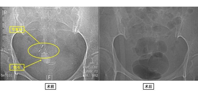 20多年前“迷失”的节育环，竟然“长出了”膀胱结石……