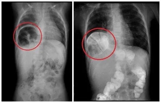 宇宇|广西1岁幼儿频繁呕吐,医院一检查,胃不见了!