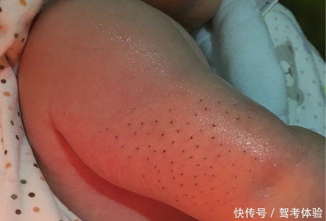 孩子|宝宝身上长“黑刺”,妈妈嫌难看一根根拔掉,第二天直接送医院!