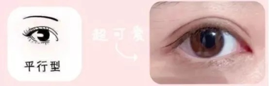 任晓霞:如何选择适合自己的双眼皮手术方式?丨科普篇