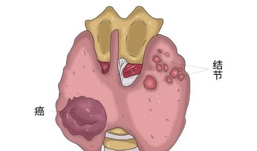 治疗方案|癌细胞明明已经扩散，为什么人依旧很精神，吃的也比较多？