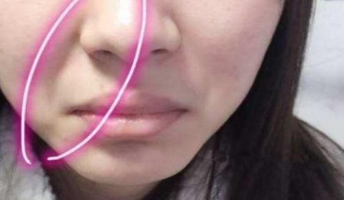 脸上有法令纹，填充玻尿酸还是做线雕？听听医生怎么说