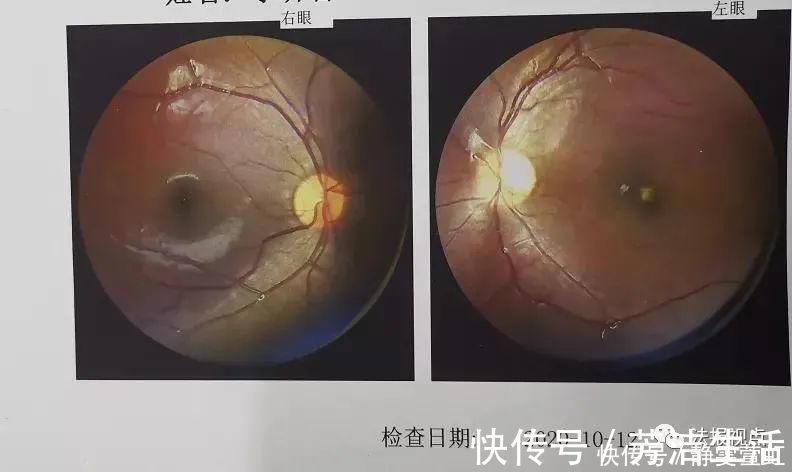 训练器|家长警惕！短短几秒，这玩具让9岁孩子永久失明