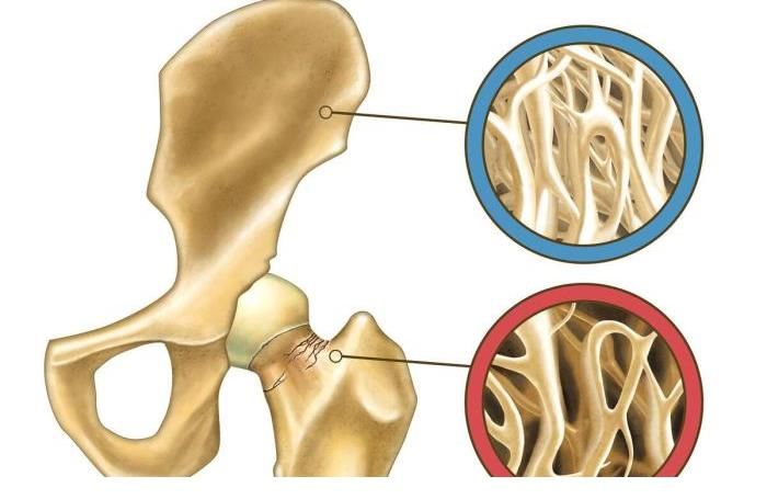 骨骼|骨质疏松不能吃花生？医生劝诫：除了花生外，这2种素食也要少吃