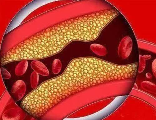 血脂异常|血脂高的人要远离豆腐？若想稳定血脂，3种“素食”或需打入冷宫