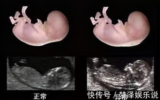 检查|世界唐氏综合征日：三类孕妇易怀“唐氏儿”，两项产检筛查很关键