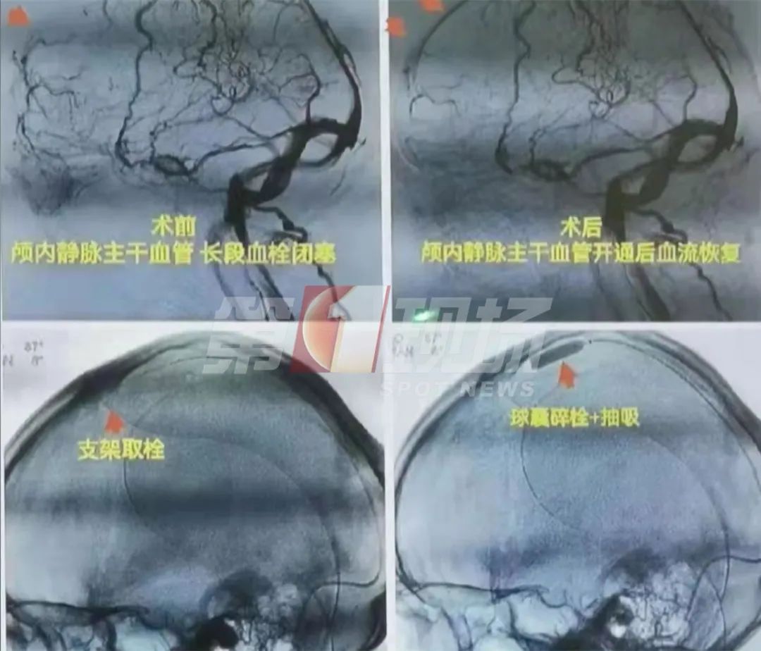 男子|奶茶“续命”？一男子喝进ICU