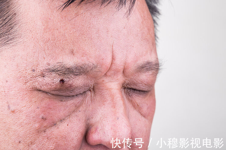 高危人群|肝癌早期不声不响?身体三个地方“变黄”,得抽空去趟医院