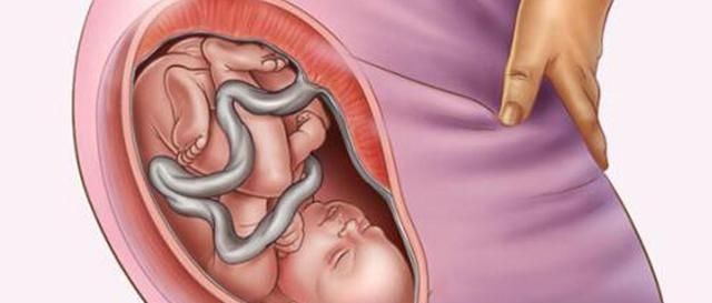 胎儿|孕期的一个习惯,导致胎儿''花式绕颈'',医生没办法只能剖了