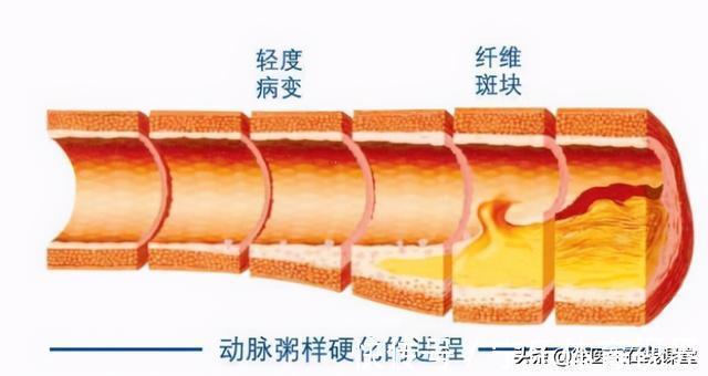 凝血功能|花生是心血管疾病的“祸根”还是营养佳品？医生本文一次讲清