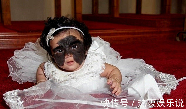 胎记|为消除胎记做7次手术,曾红遍网络的“蝙蝠侠”女孩,如今成这样