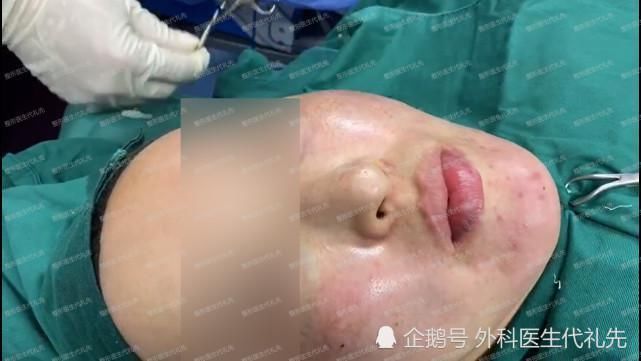 苹果肌|做脂肪填充之后,会下垂得更厉害?更容易显老?准备做面填的人来看看