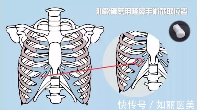 肋软骨 想做隆鼻手术，医生居然要取我的肋骨？