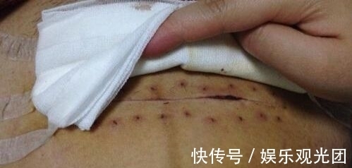 伤口|剖腹产,竖切口和横切口有什么区别?作为产妇,应该怎么选择