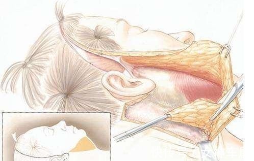 面部 46岁做拉皮手术是种什么体验,分享一下我的真实经历!