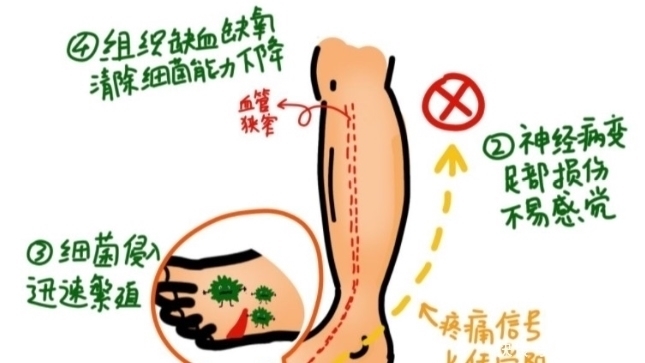 手脚|糖友们请当心，当手脚出现这些症状，糖尿病足或许已经不远了