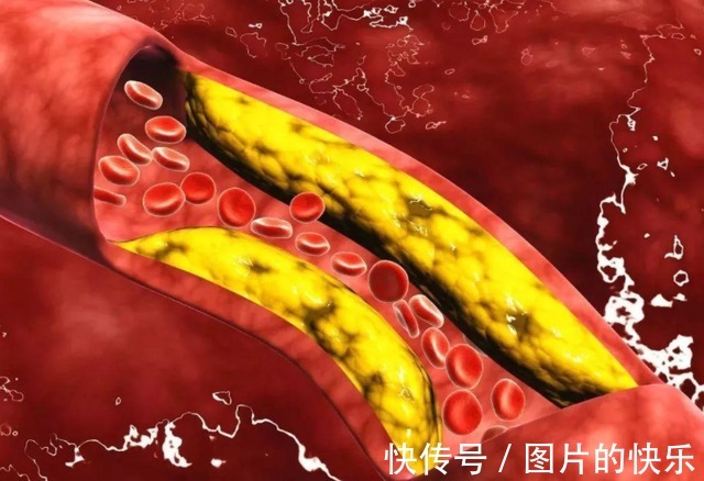 身体健康|瓜子吃多了会堵血管?医生提醒:若想养血管,2件事要做好