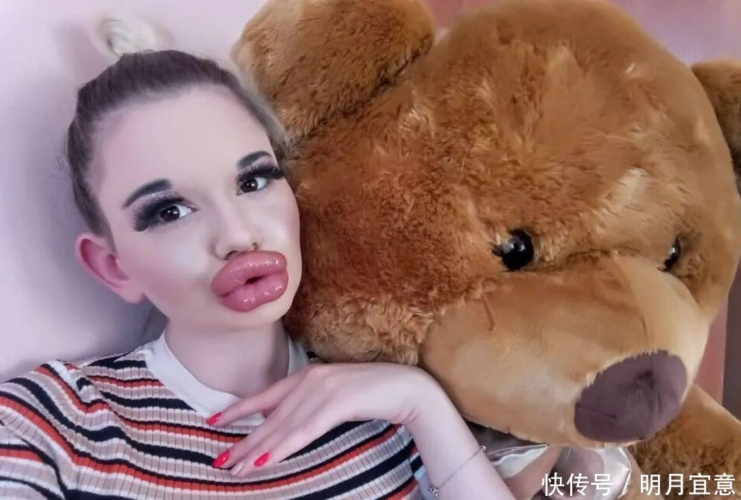 21次丰唇手术之后,这个妹子的嘴唇现在长这样…