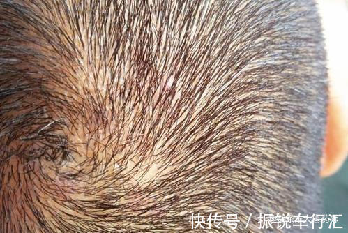 脓包|几天洗一次头最好?头发一湿就用洗发水?几个洗发误区,值得了解