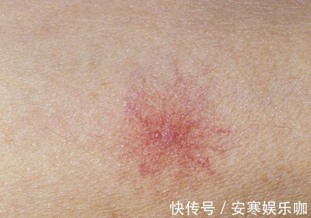 肝脏|女子误以为过敏,被查出肝癌,医生:身体3种“异常”,快查肝CT