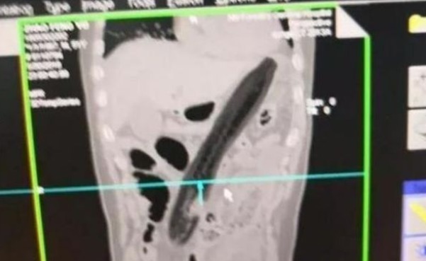 医生|30厘米的黄瓜快顶到心脏了,医生也束手无策,直摇头