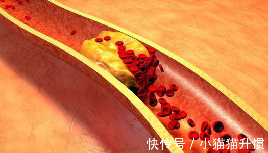 高脂血症|高血脂不能吃什么高血脂不吃药能不能恢复正常医生说明！