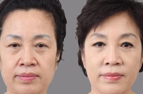 胶囊|口周皱纹消除也没那么难,只要坚持做这美容院打死不会说的5件事