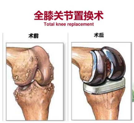 膝关节|潍坊市中医院专家为您解答膝关节置换是“忍无可忍”？还是“长痛不如短痛”？