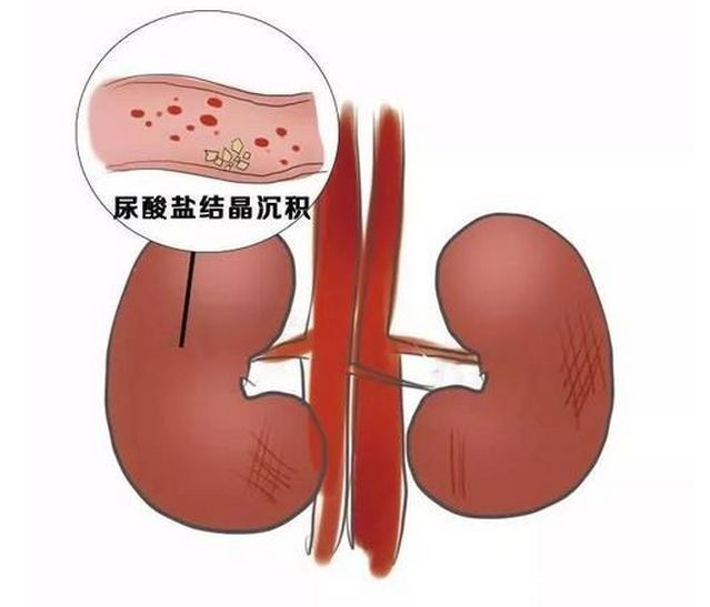 发病|冬季,痛风高发,这4类人,一旦出现3个症状,尿酸高的可怕了