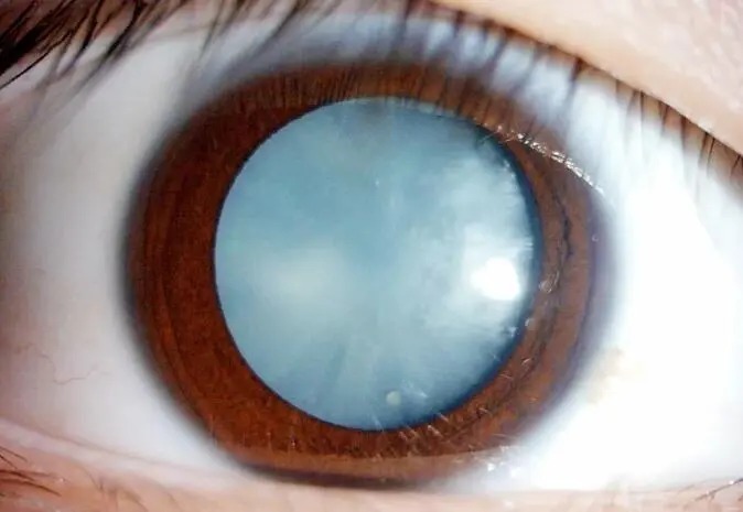 小林|还在可乐饮料当水喝?当心喝出糖尿病性白内障