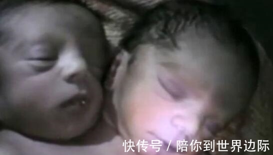 连体婴儿|刚出生的婴儿有两个头,竟是妈妈的无知造成的!