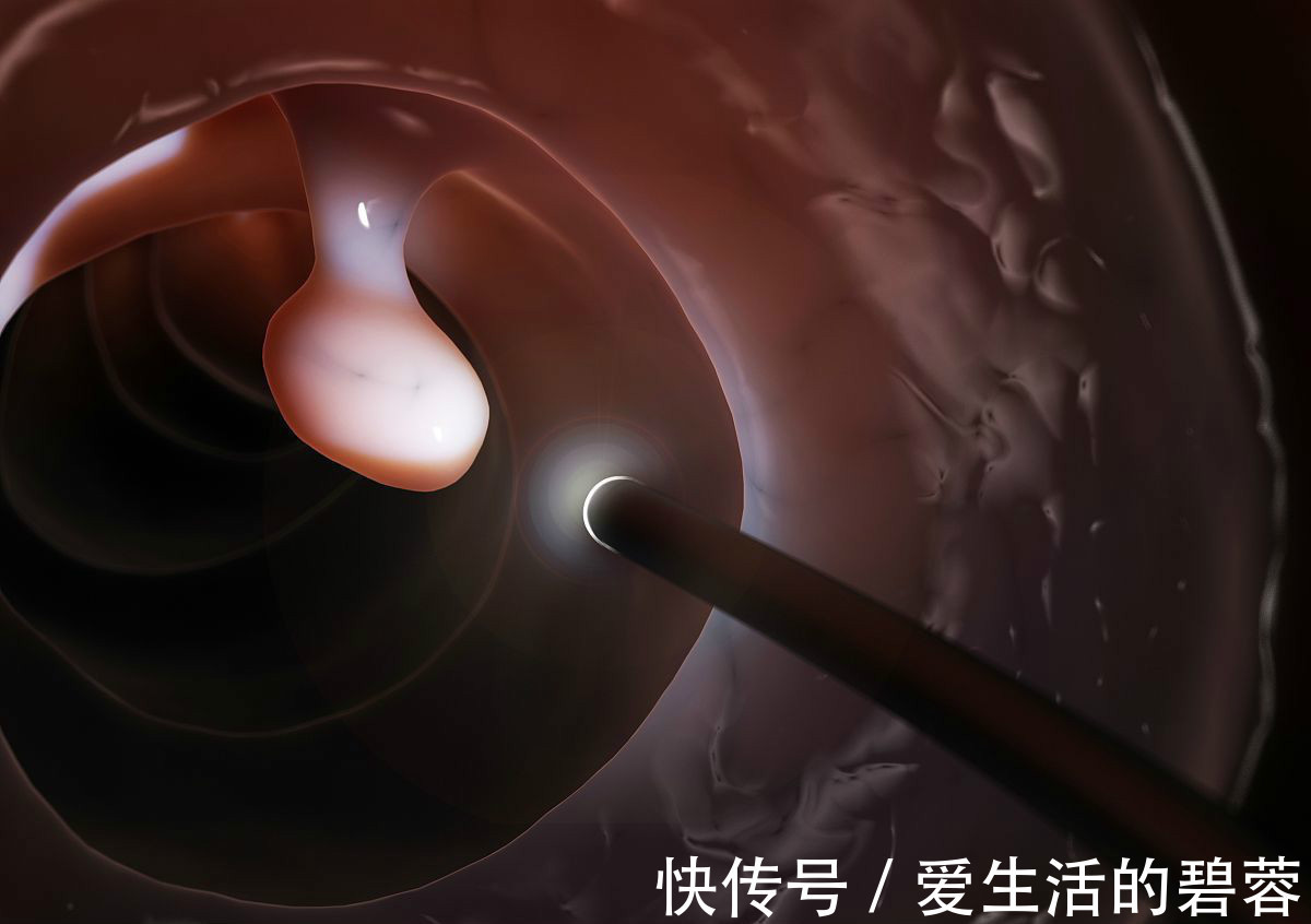 腺瘤性息肉|两种息肉一定要及时切除,拖的太久会变成进展期癌症