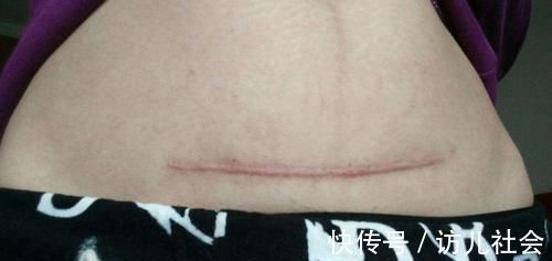 免疫系统|剖腹产的娃,智力上会输给顺产的?并不是,顺与剖最大区别是这些