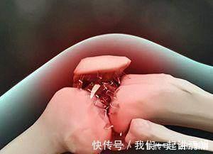 真相|掰手指关节会咔咔发响到底好不好很多人都不知道,真相很简单