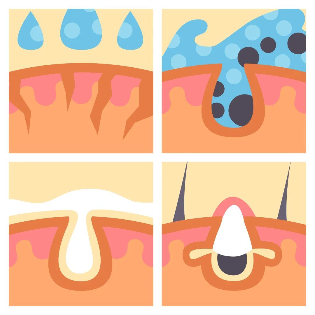 水杨酸|问：换季皮肤不适时该用些什么？