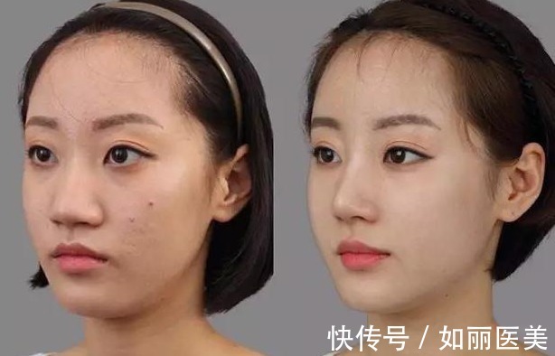 肋软骨 想做隆鼻手术,医生居然要取我的肋骨?